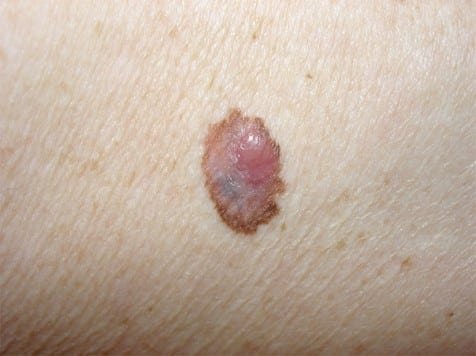 Billede af malignt melanom, også kaldet modermærkekræft