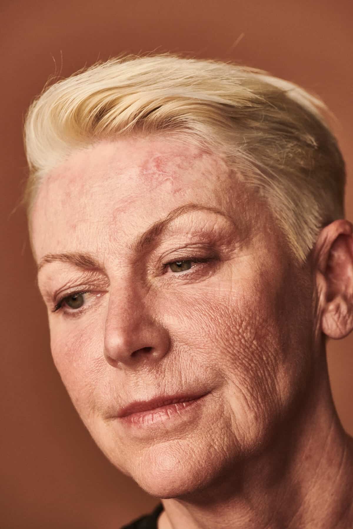 Patient behandlet med Mohs kirurgi i panden