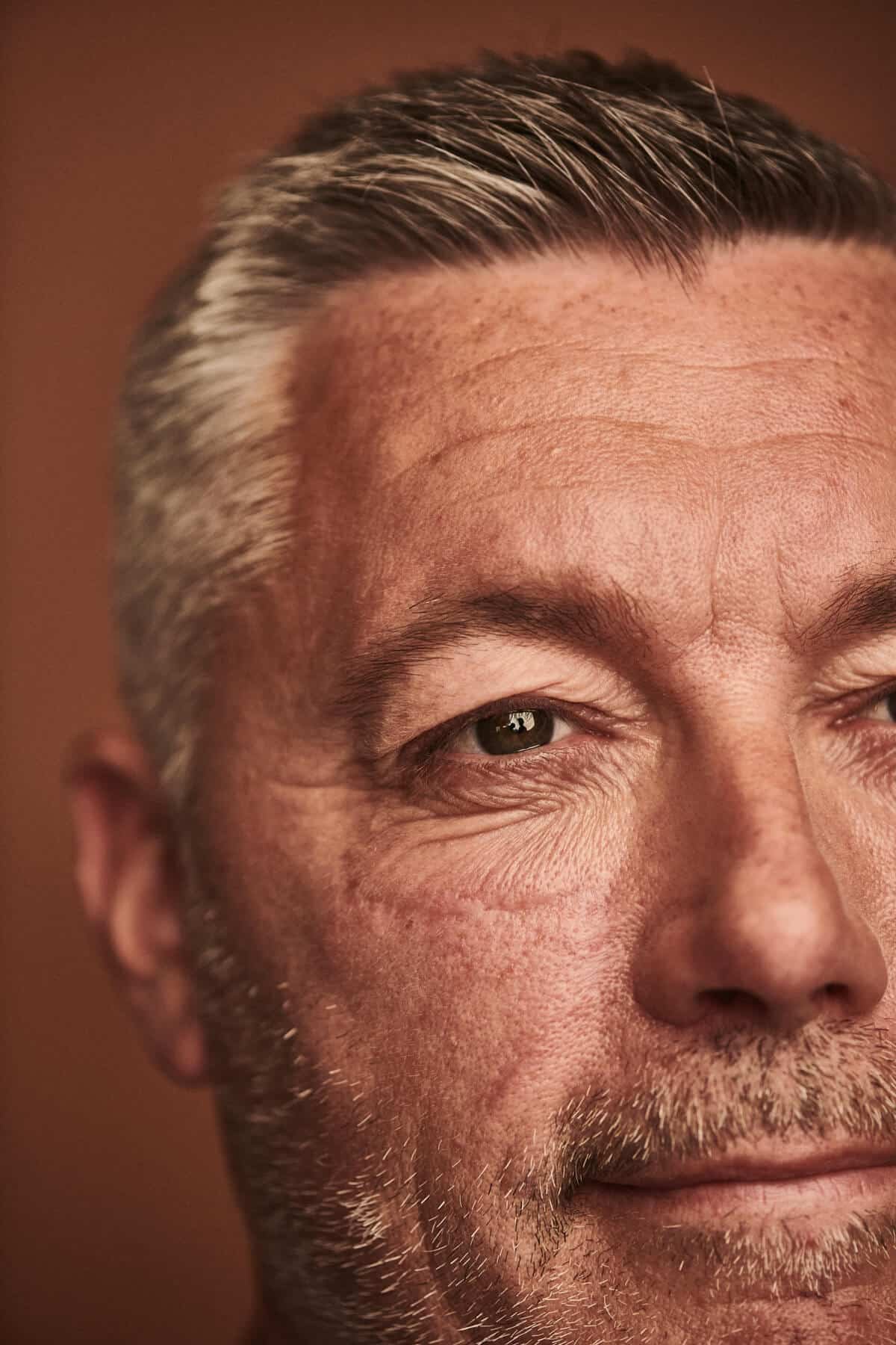 Patient behandlet med Mohs kirurgi under øjet