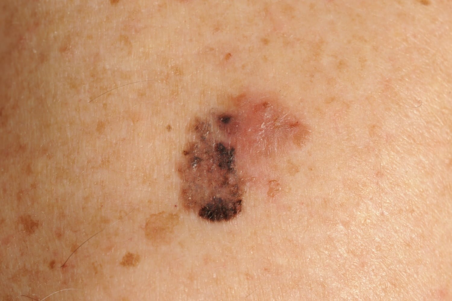 Billede af malignt melanom, også kaldet modermærkekræft