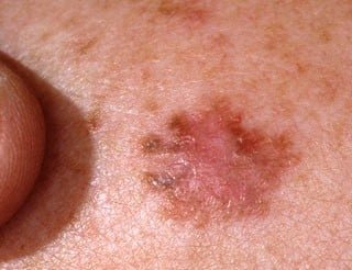 Billede af malignt melanom, også kaldet modermærkekræft