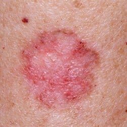 Billede af Basalcellekræft