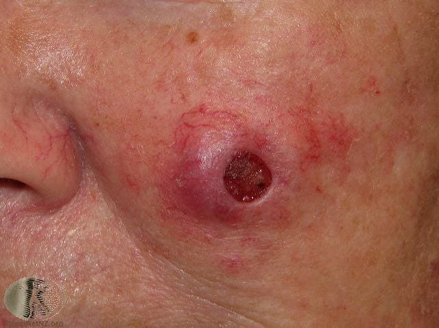 Billede af Pladecellekræft